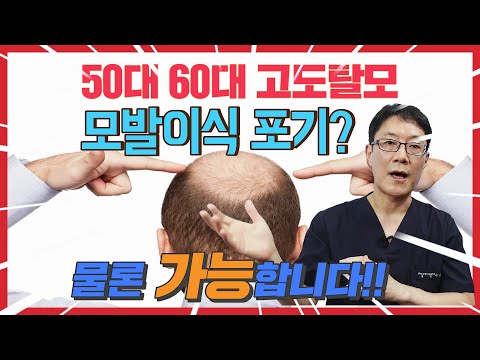 나도 모발이식이 가능할까? 고도탈모라도 뒷머리는 대부분 좋으십니다.대량모발이식 하루에 하시거나 1차 2차 두번 하셔도 됩니다.