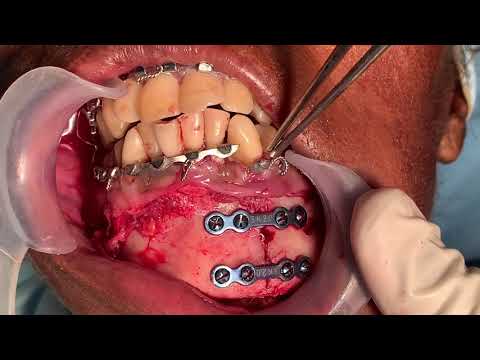 Lower Jaw Fracture Of Mandibular Fracture: Redo Surgery