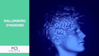 Understanding Wallenberg Syndrome: Causes, Symptoms, and Treatment - @mdmedicine.network