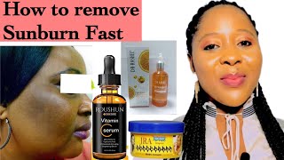 How To Remove Sunburn From Face Fast | sunburn cream |