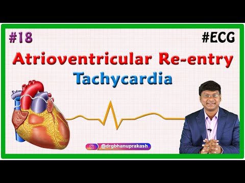 18. Atrioventricular Re-entry Tachycardia  & Atrioventricular Nodal Reentrant Tachycardia