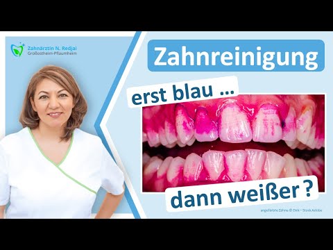 Zahnreinigung: Warum machen wir die Zähne blau bevor wir sie weiß machen? Zahnarzt Großostheim