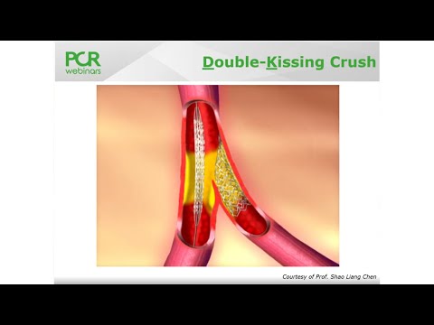 Case-based step-by-step DK-crush technique in a bifurcation - Round Table Webinar
