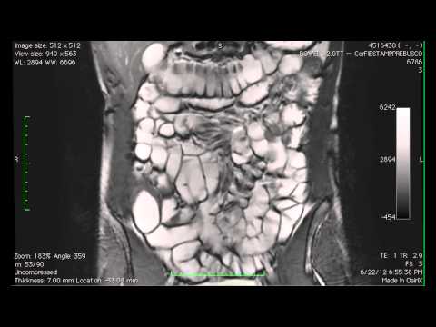 Cine MR imaging of the small intestine in a case of bowel MRI