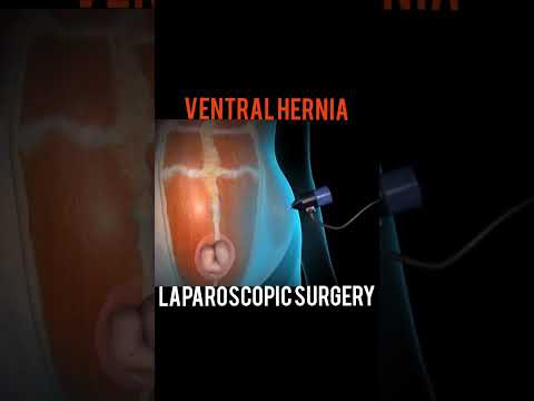 Ventral Hernia Laparoscopy Surgery  #ytshorts