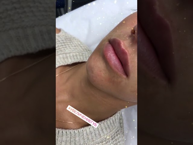 Увеличение губ