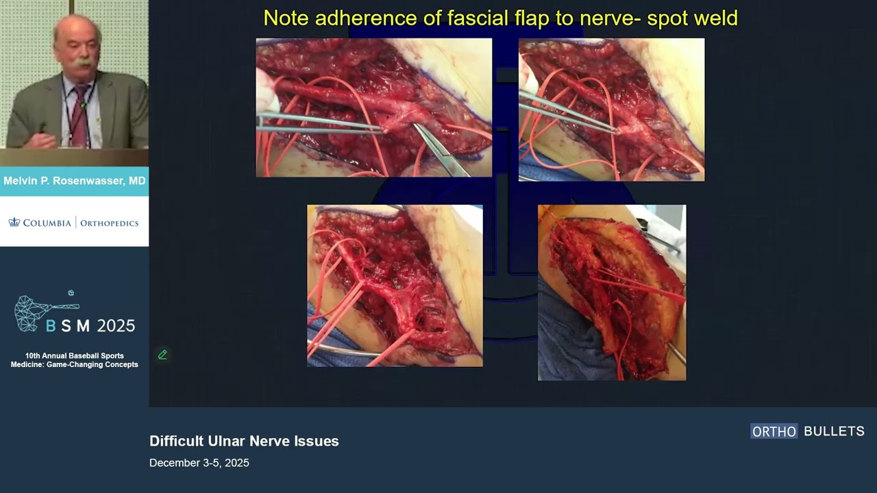 Difficult Ulnar Nerve Issues_Melvin Rosenwasser MD