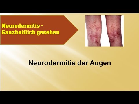 Nejrodermit bei den zukünftigen Kindern Ob man den roten Kaviar bei wem die Schuppenflechte essen kann