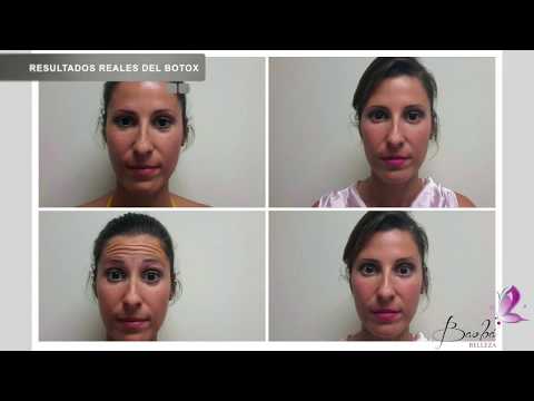 Resultados REALES del BOTOX – Madrid