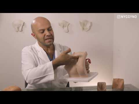 What is a G-Spot injection?