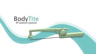 BodyTite - RF Assisted Lipolysis