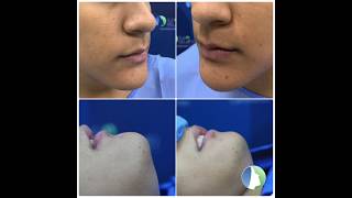 MENTOPLASTIA DE REDUCCION CON CIRUGIA MAXILOFACIAL