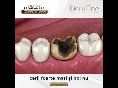 Dantură fixă pe implanturi: totul despre tratament, materiale și costuri