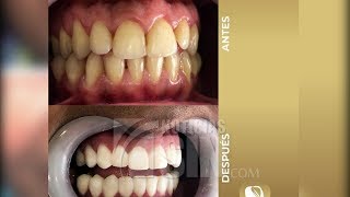 “Los PROS y los CONTRAS” de los Diseños de Sonrisa