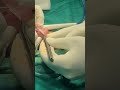 Laser Frenuloplasty Frenectomy Live Surgery Get Rid Of Short Frenulum In Less Than A Minute