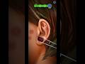 Doctor ‍ ️ne Nikale Kaan Ke Kide Full Treatment Video