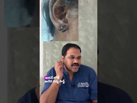 Ear lobe glue versus surgical repair video by Dr. Ram Prabhu.