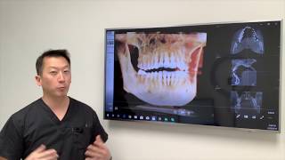 What are some complications that could happen in a minority of cases after wisdom teeth removal?