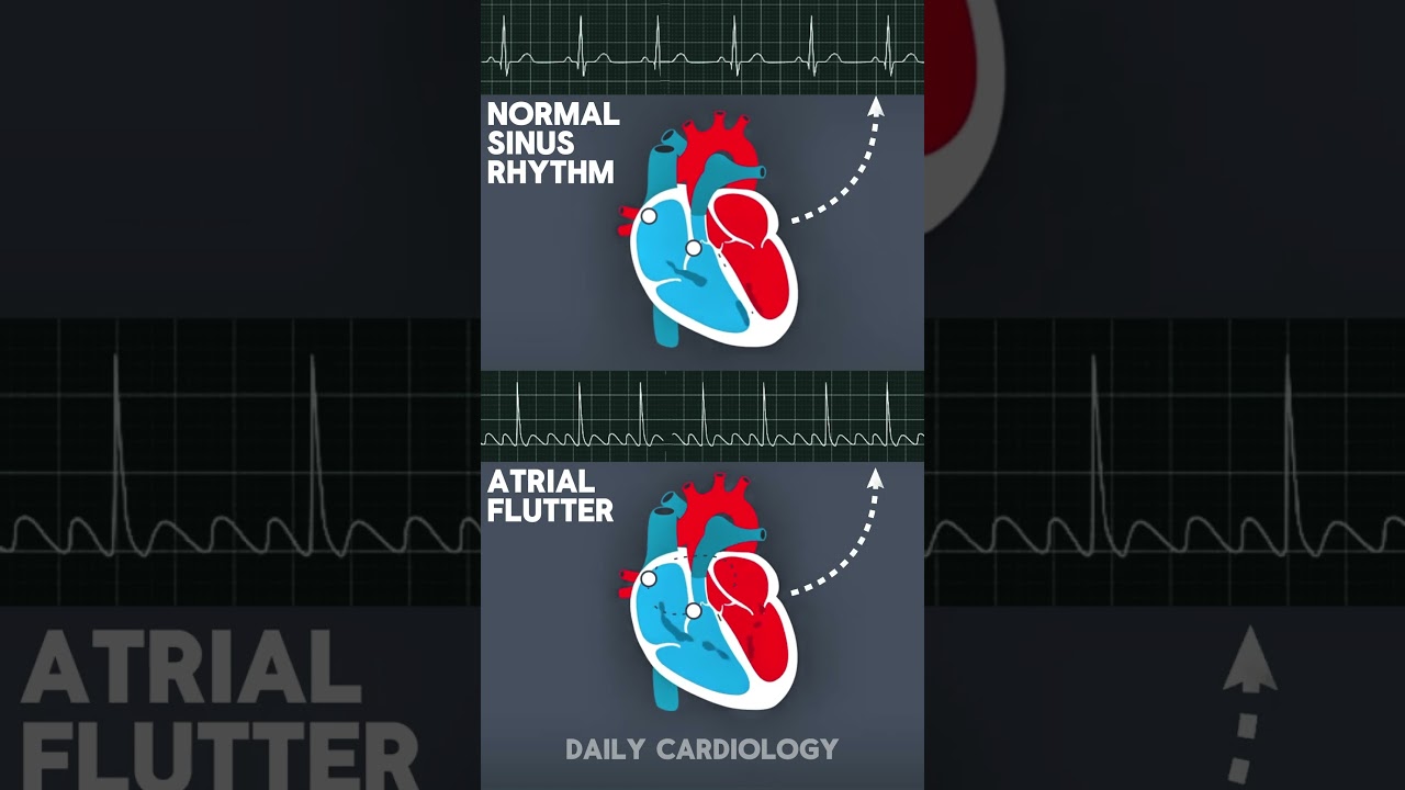Normal Sinus Rhythm & Atrial Flutter (ECG vs Animation) #shorts #ecg #cardiology #hearthealth