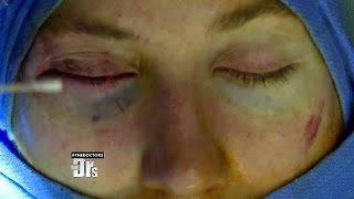 New Surgery to Get Trendy Bedroom Eyes?