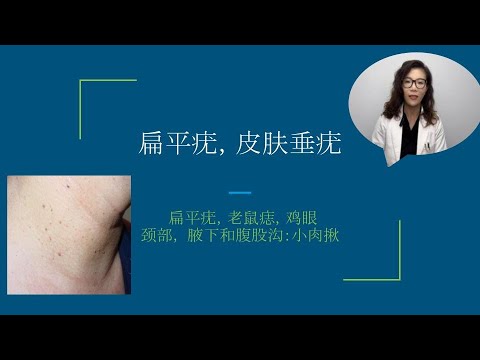 老鼠痣