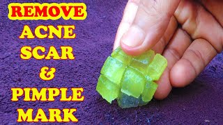 4 SIMPLE NATURAL REMEDIES FOR ACNE SCARS | REMOVE PIMPLE SCARS FROM FACE NATURALLY at home