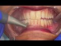 Teeth Scaling And Polishing By Dentist