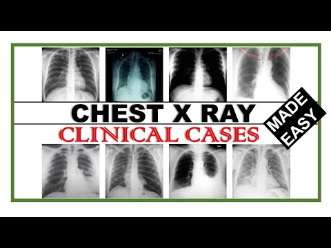 Chest X Ray Clinical Cases | How to read Chest X Ray | Dr Asif Lectures