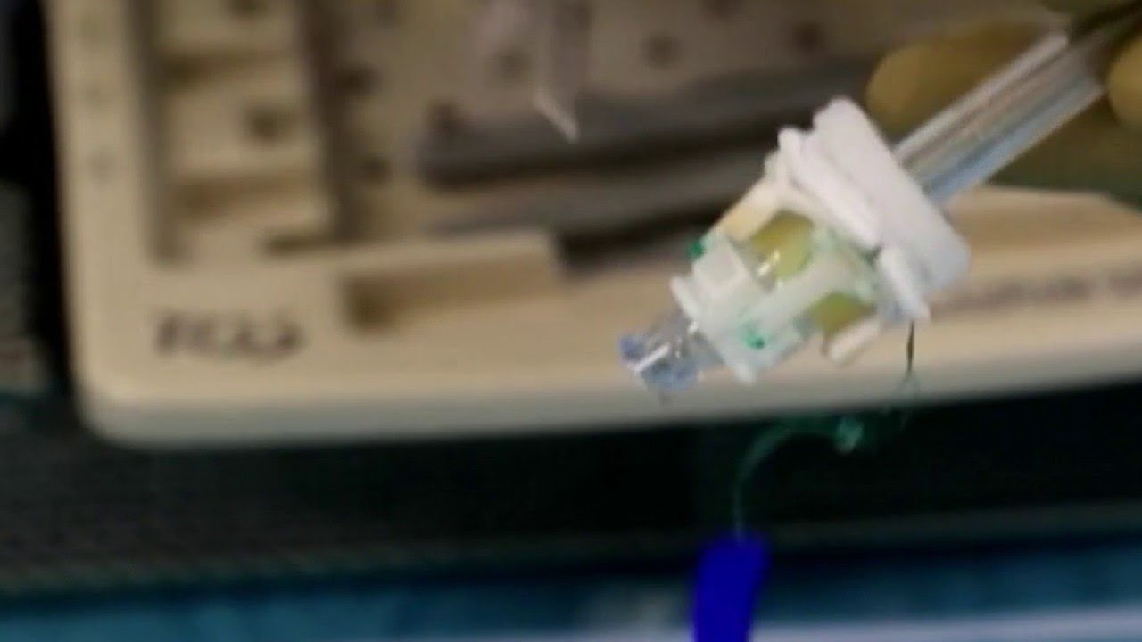 Santé - Valve cardiaque : la technique mini-invasive