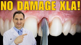Atraumatic Extraction in Dentistry | As Learned from Practical Implantology