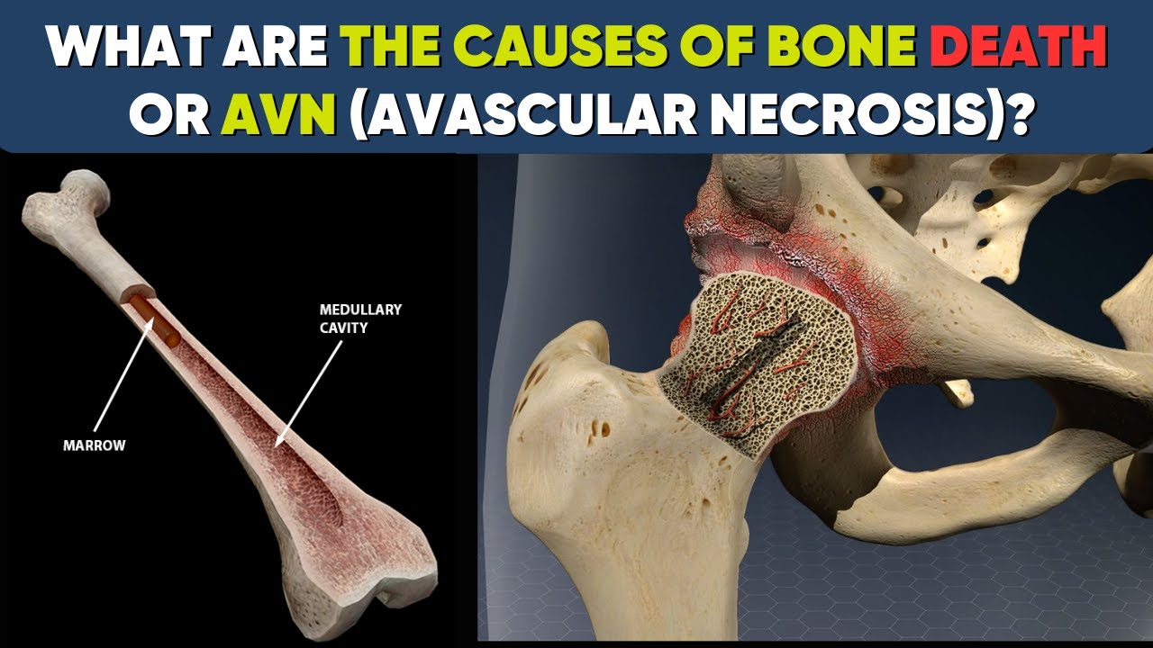 5 top causes of AVN of hip & more #avascularnecrosis #shortsindia