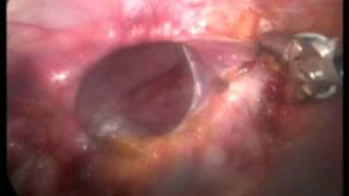 preview picture of video 'G. Skrekas MD - Laparoscopic umbilical hernia repair.mp4'