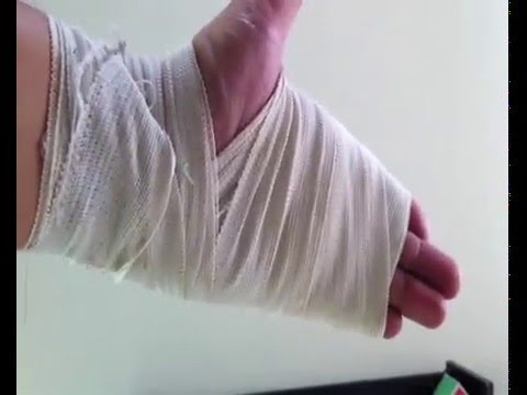 VENDA DE ROLLO: MANO PARCIAL