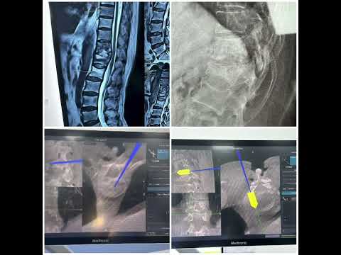 Robotic spine surgery in spinal infection - Dr. Ajay Kothari