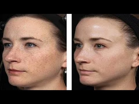 Hogyan lehet eltávolítani a vörös öregségi foltokat az arcról