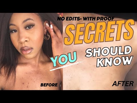 Say Goodbye to Dark Spots and Acne Scars with These Tricks || how to get rid of dark spots