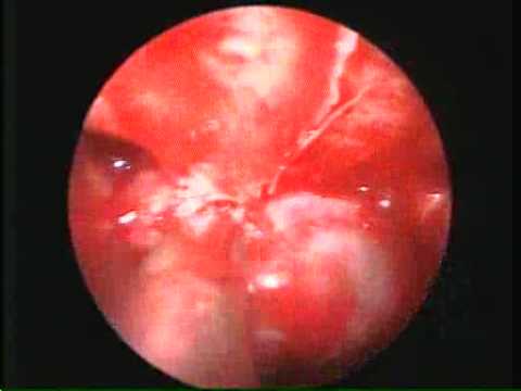 Endoscopic transnasal transsphenoidal resection of pituitary macroadenoma 2