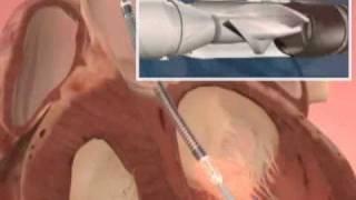 The Impella Device for Heart Failure