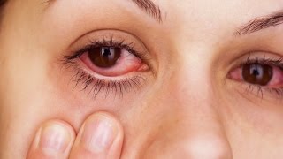 How To Instantly Relieve Itchy/Irritated Allergy Eyes!!
