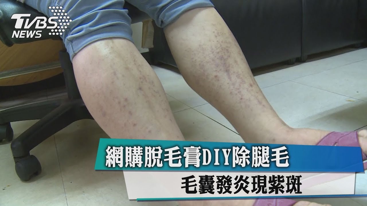 網購脫毛膏DIY除腿毛　毛囊發炎現紫斑
