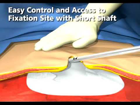 AbsorbaTack™ 20 Short Product Animation for Open Ventral Hernia Repair 54Lg2CEbDiE