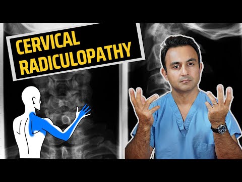 Cervical Radiculopathy