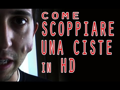 Ciclismo e articolazioni Fase 3 gonartrosi al ginocchio