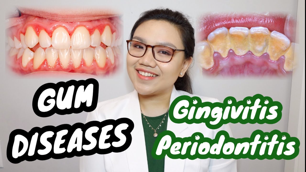 GUM DISEASE: Gingivitis and Periodontitis 🦷 Namamagang gilagid, masama ba | Dr. Bianca Beley