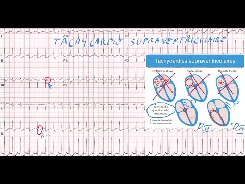 20 ECG - Quiz - Dr Synapse