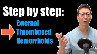 Step by step guide: External Thrombosed Hemorrhoids