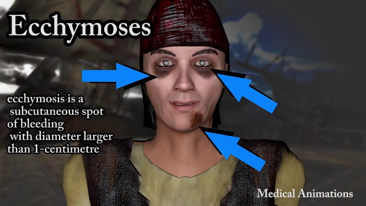 Scurvy Symptoms- vitamin c deficiency Symptoms - Medical Animation - YouTube