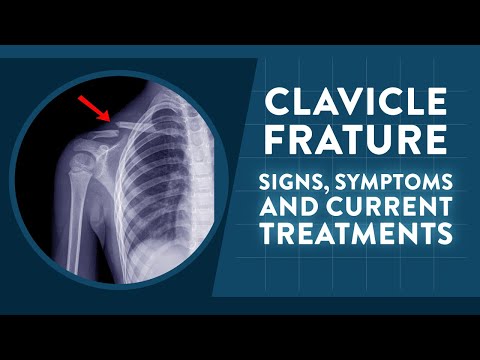 Clavicle fracture: Signs, symptoms and current treatments