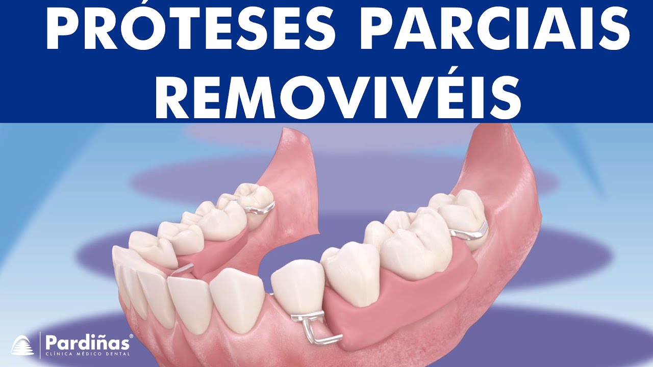 Próteses parciais removivéis ©