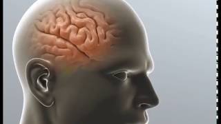 Brain Tumor SurgeryVideo In India Brain Tumor SurgeryVideo In India